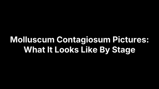 Molluscum Contagiosum Pictures: What It Looks Like By Stage