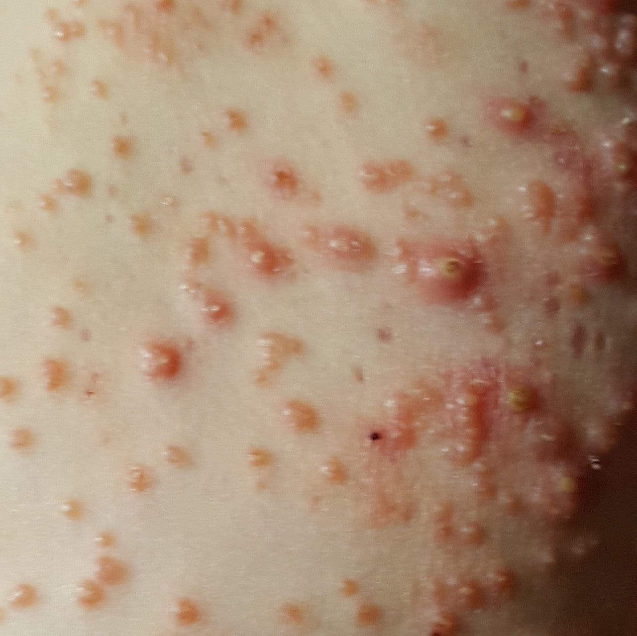 Extra Large Hydrocolloid Patches